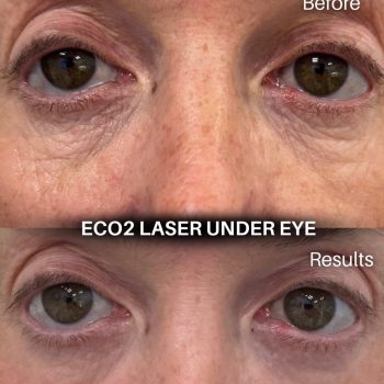 eco2 LASER 2